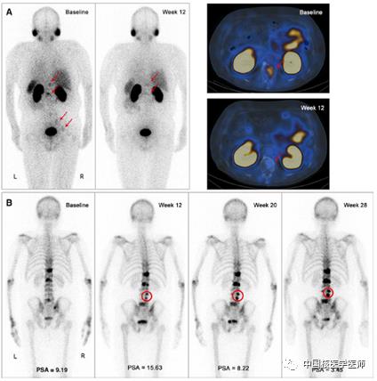SPECT/CT诊疗一体化定量技术前沿进展、复旦大学附属肿瘤医院开展转移性去势抵抗性前列腺癌(mCRPC)新型激素治疗疗效评估
