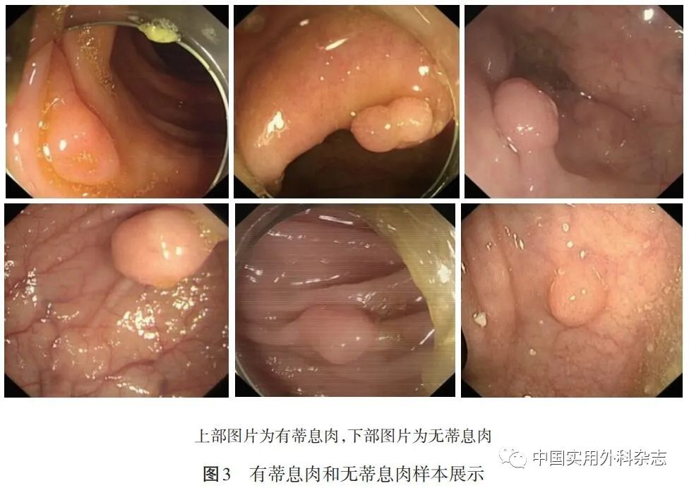 论著｜基于深度学习人工智能在结肠镜检查中应用研究