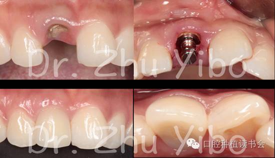 牙根屏障即刻种植术-Socket Shield Technique 的前世今生