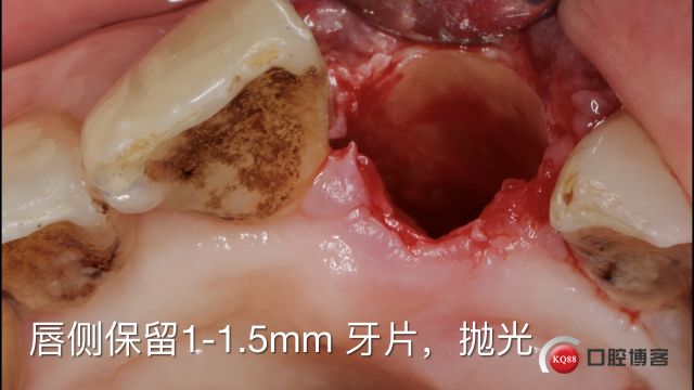 Socket Shield technique