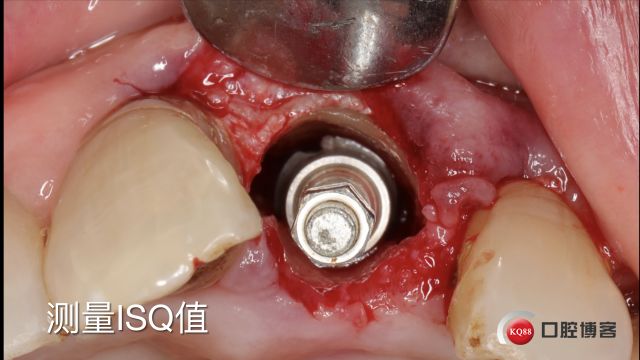 Socket Shield technique