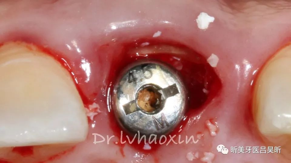 美学区根屏障技术（socket-shield)+IPR一例