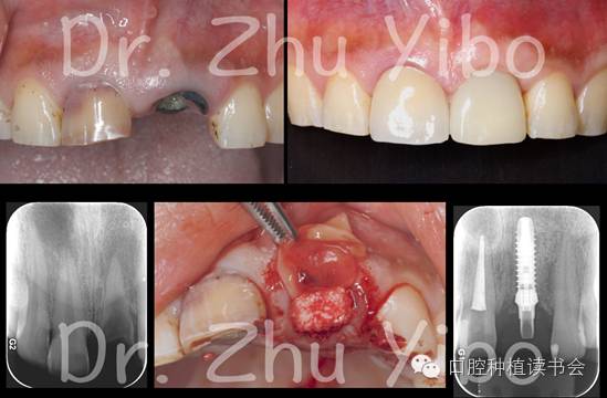 牙根屏障即刻种植术-Socket Shield Technique 的前世今生