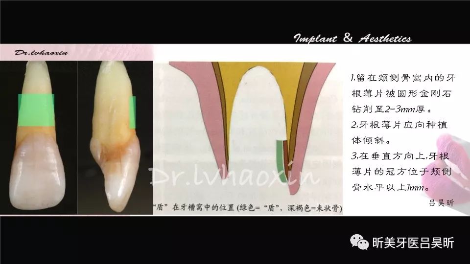 美学区根屏障技术（socket-shield)+IPR一例