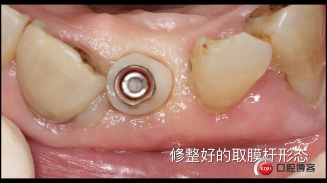 Socket Shield technique