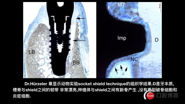 Socket Shield technique