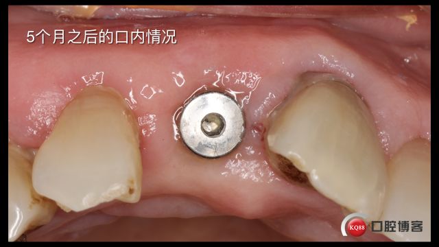 Socket Shield technique