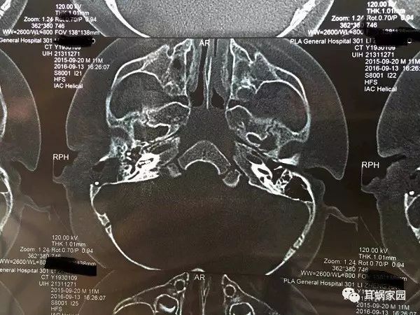 美国AB耳蜗HiFocus Mid-Scala MS电极详解