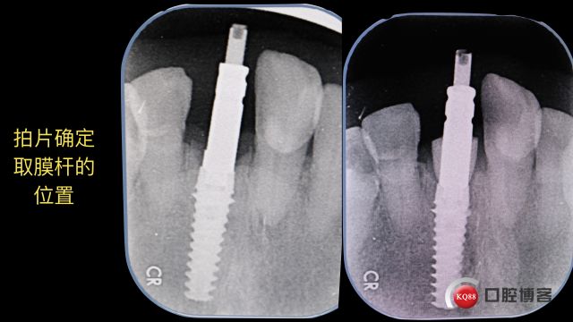 Socket Shield technique