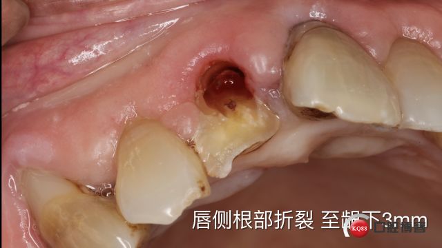 Socket Shield technique