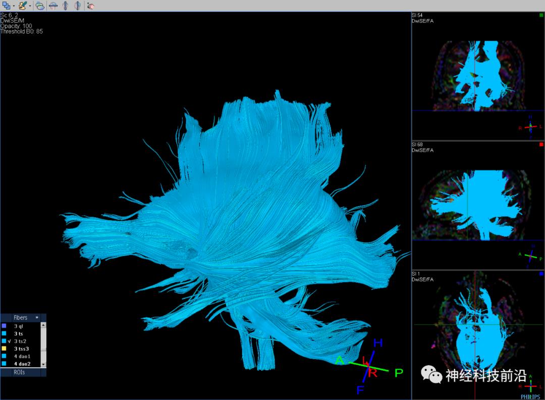 人工智能与DTI神经纤维束成像