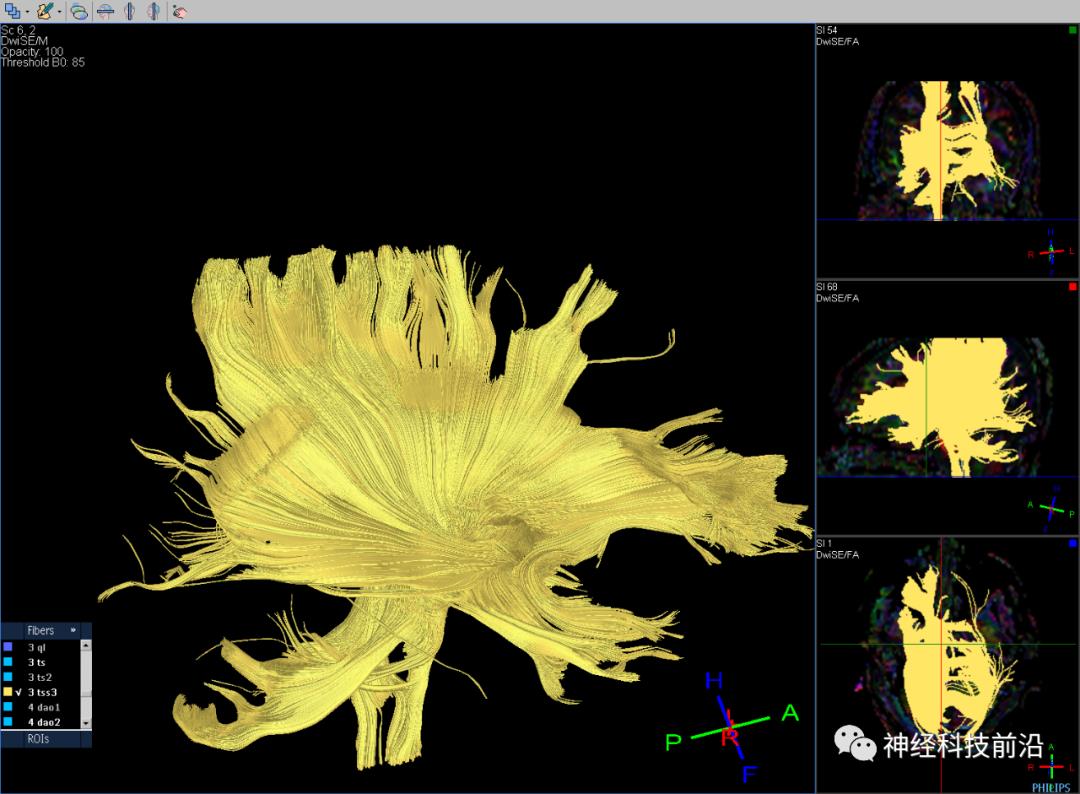 人工智能与DTI神经纤维束成像