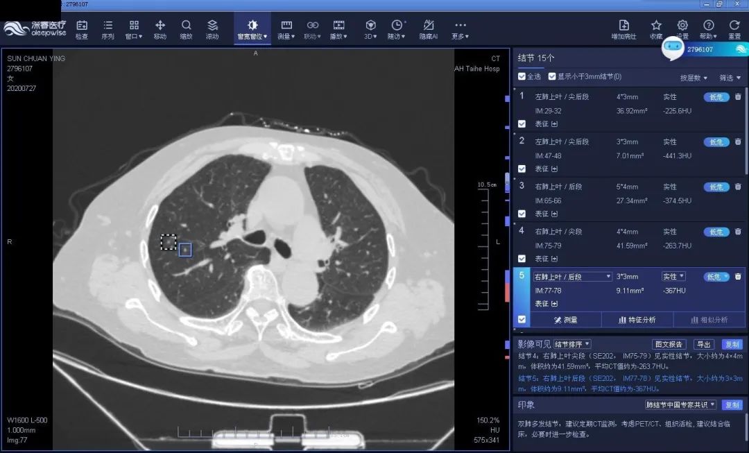 人工智能助力医疗影像,让肺结节无处可逃