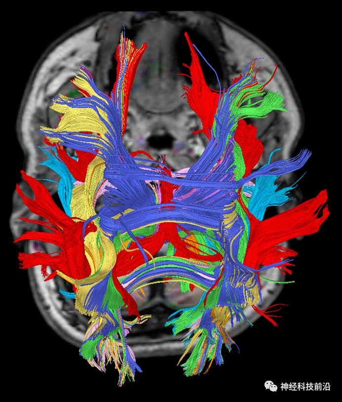 人工智能与DTI神经纤维束成像