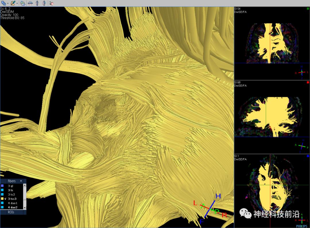 人工智能与DTI神经纤维束成像