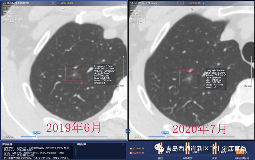 人工智能让肺小结节无处遁形！西海岸新区人民医院“人工智能AI报告”精准评估“肺小结节”