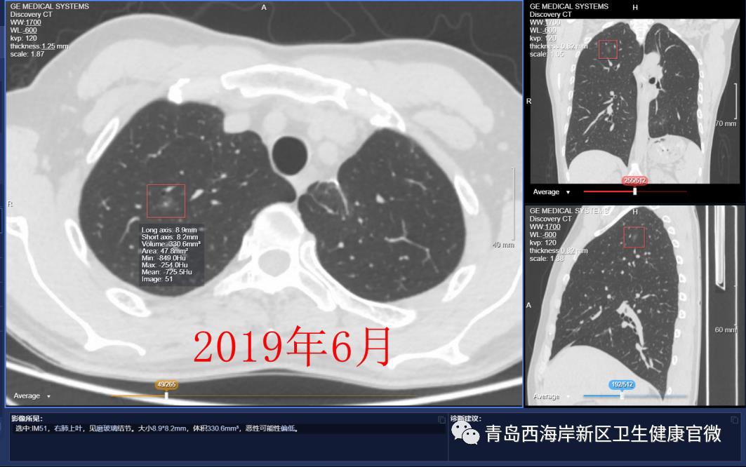 人工智能让肺小结节无处遁形！西海岸新区人民医院“人工智能AI报告”精准评估“肺小结节”