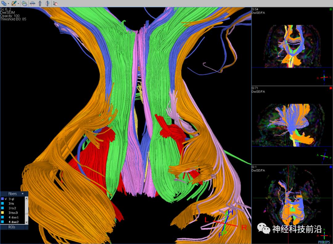 人工智能与DTI神经纤维束成像