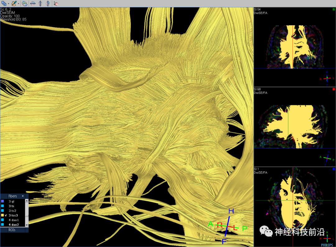 人工智能与DTI神经纤维束成像