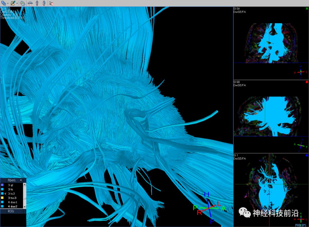 人工智能与DTI神经纤维束成像