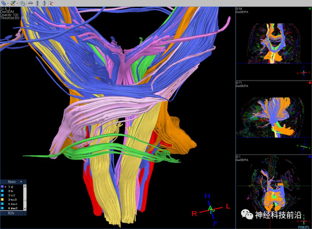 人工智能与DTI神经纤维束成像