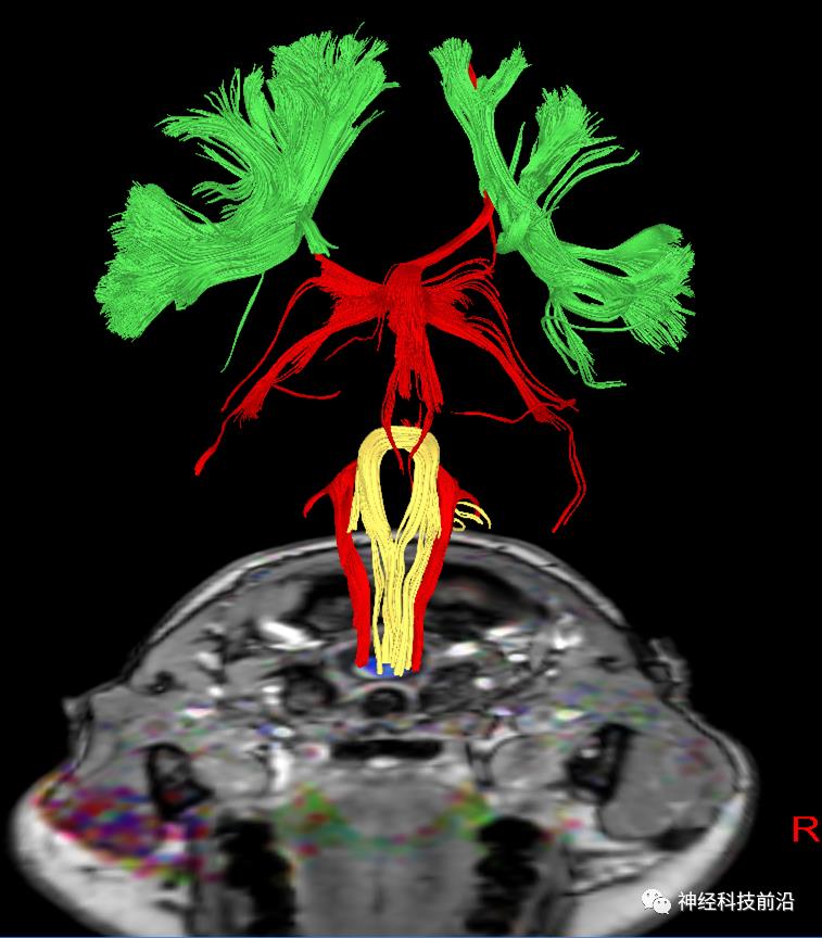 人工智能与DTI神经纤维束成像