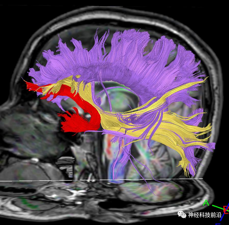 人工智能与DTI神经纤维束成像