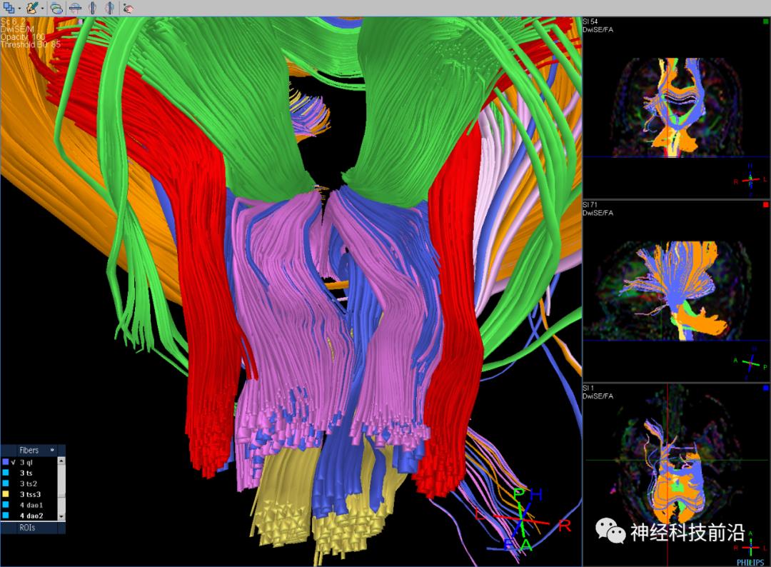 人工智能与DTI神经纤维束成像