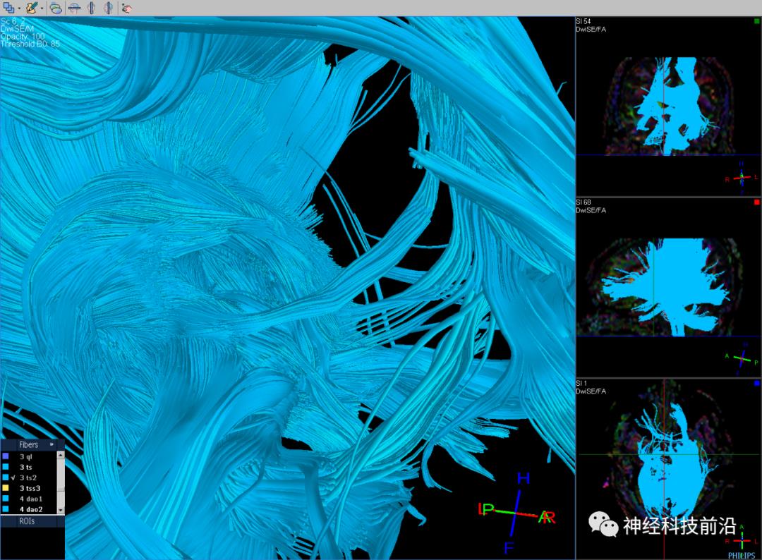 人工智能与DTI神经纤维束成像