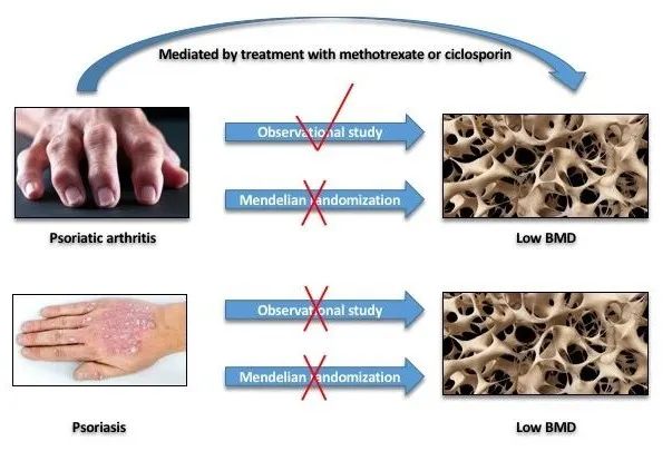大数据研究终结银屑病与骨质疏松关系的争论，为临床指南提供了新证据