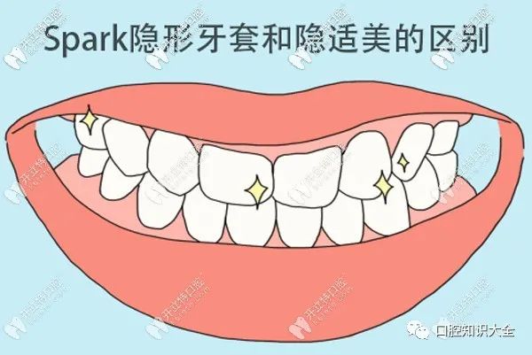 Spark隐形牙套和隐适美哪个好，区别是什么？