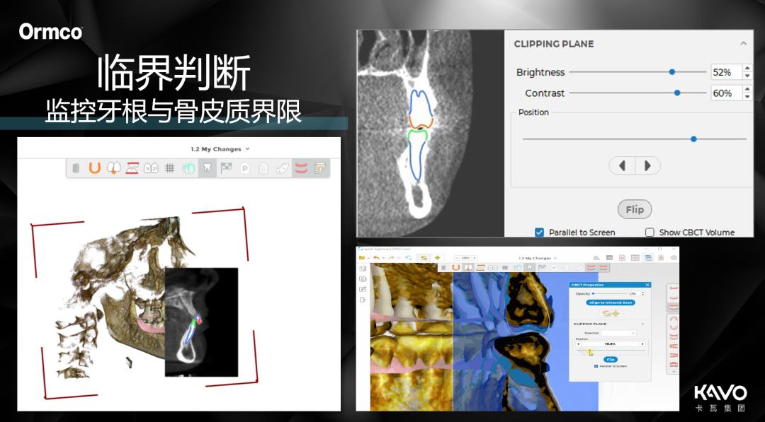 隐形新势力 牙根黑科技 | SPARK®精靓®邂逅CBCT