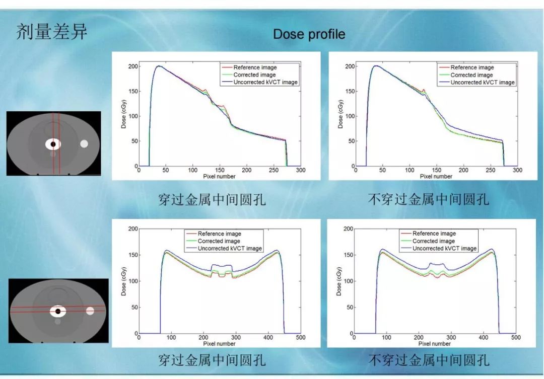 【分享】运用 MVCBCT 去除 KVCT 图像中的金属伪影