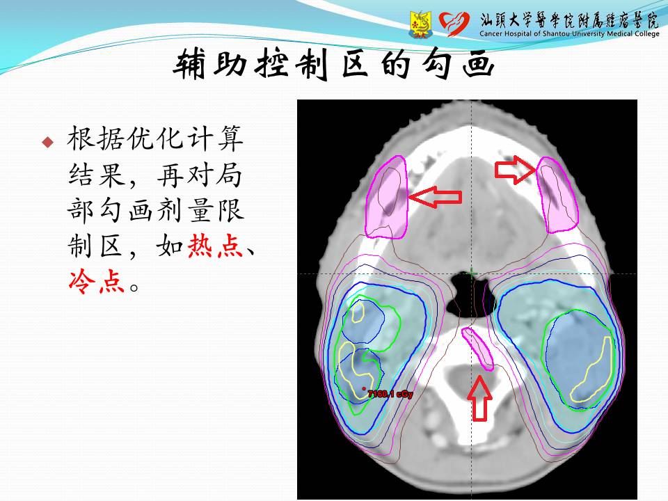 基于 Eclipse 计划系统的容积调强计划设计——经验交流