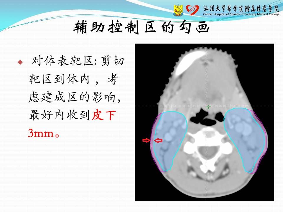 基于 Eclipse 计划系统的容积调强计划设计——经验交流