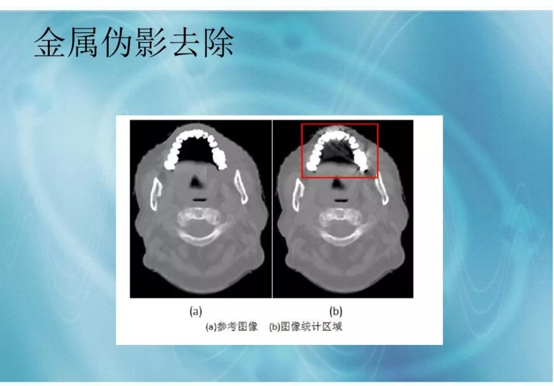 【分享】运用 MVCBCT 去除 KVCT 图像中的金属伪影