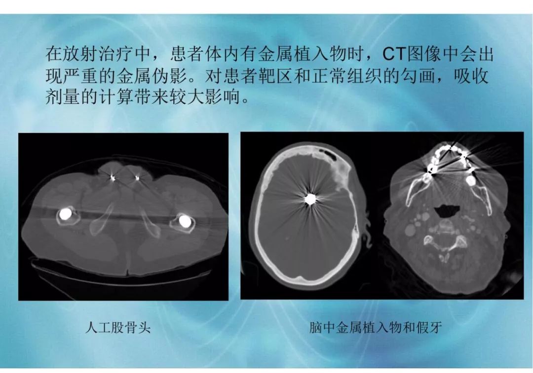 【分享】运用 MVCBCT 去除 KVCT 图像中的金属伪影