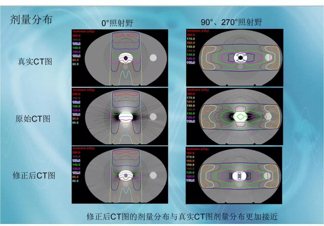 【分享】运用 MVCBCT 去除 KVCT 图像中的金属伪影