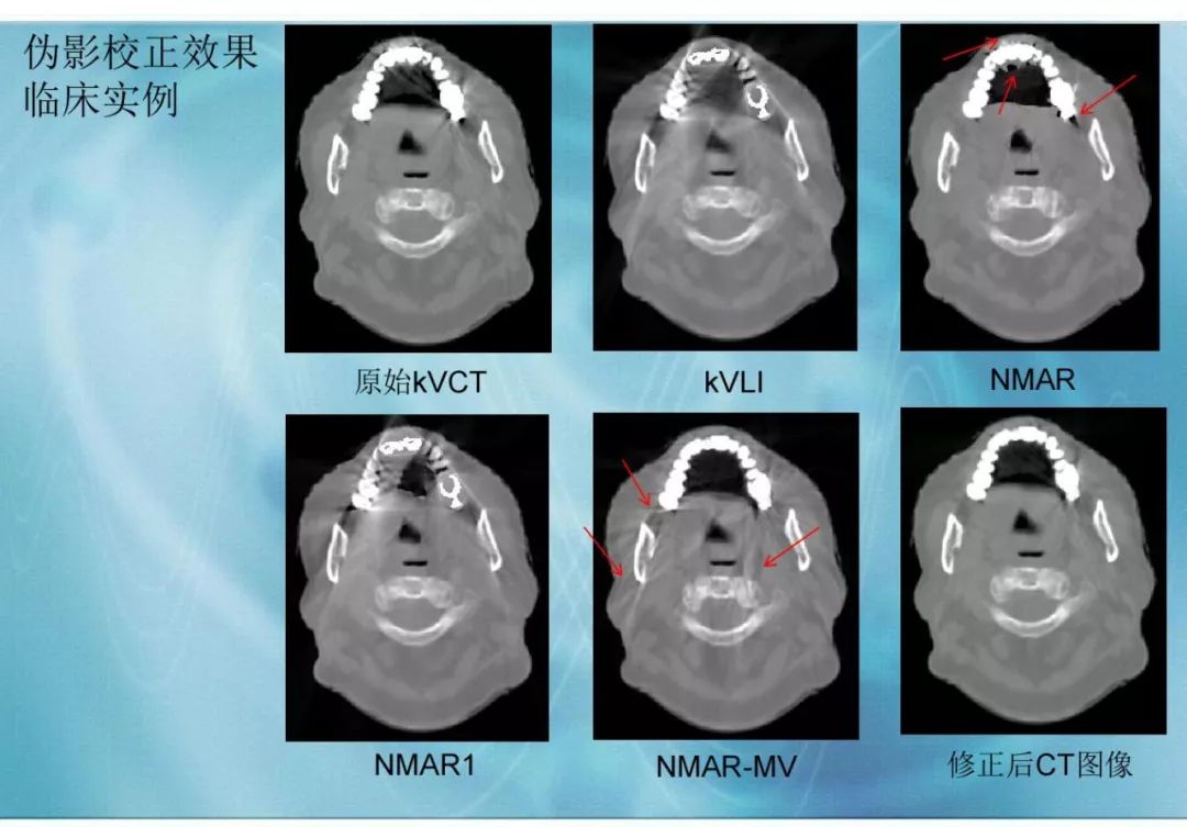 【分享】运用 MVCBCT 去除 KVCT 图像中的金属伪影