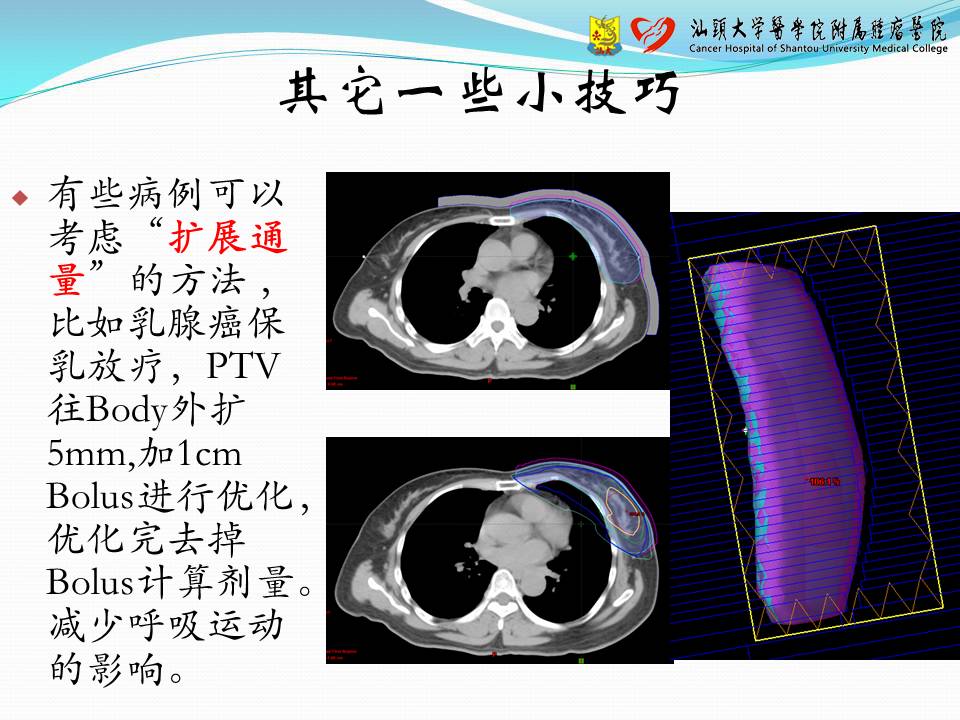 基于 Eclipse 计划系统的容积调强计划设计——经验交流