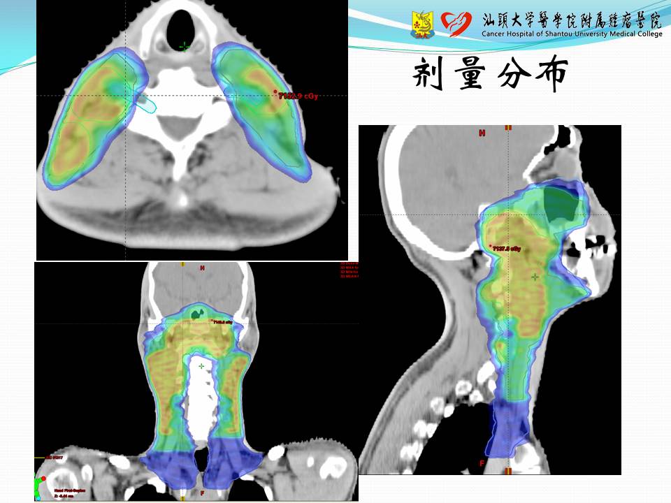 基于 Eclipse 计划系统的容积调强计划设计——经验交流