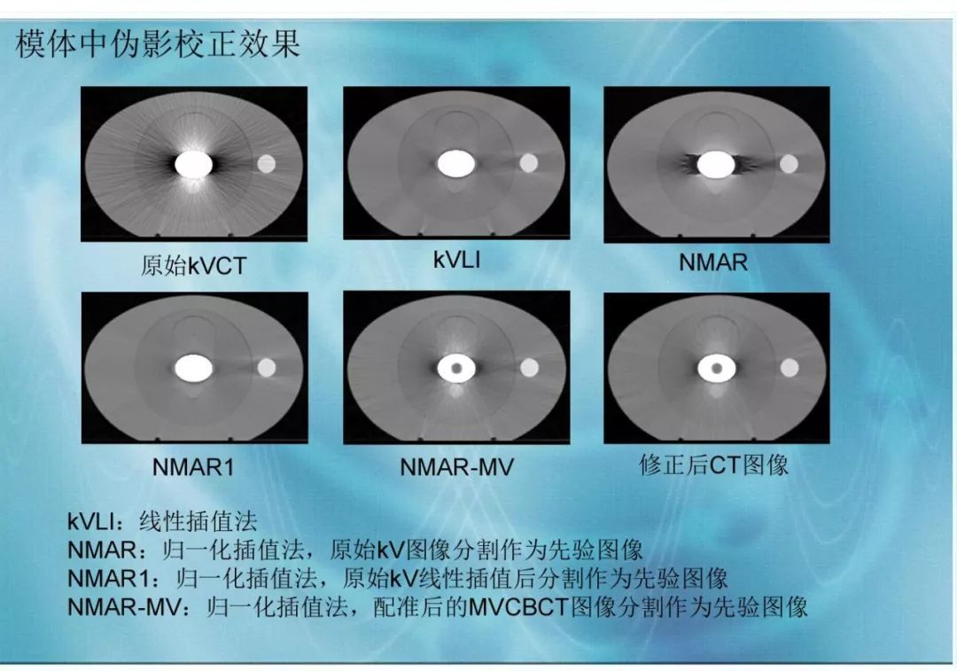 【分享】运用 MVCBCT 去除 KVCT 图像中的金属伪影