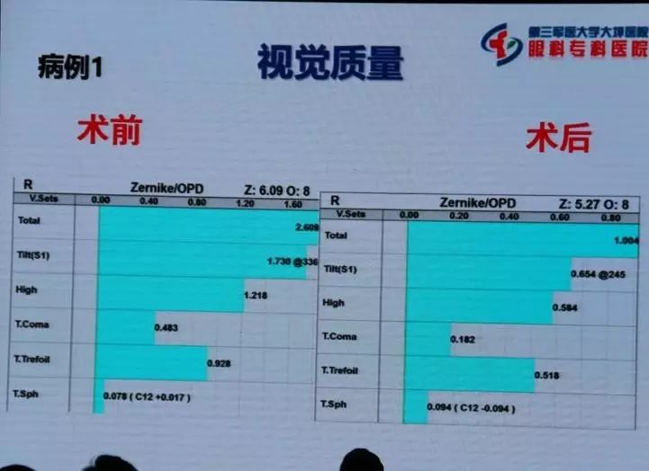 新无级，创视纪——TECNIS Symfony®新无级晶英汇盛况聚焦