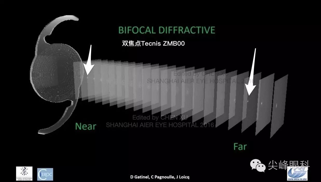 尖峰眼科 | 也谈Symfony新无极人工晶体（下）：纸上谈兵之临床效果比较篇