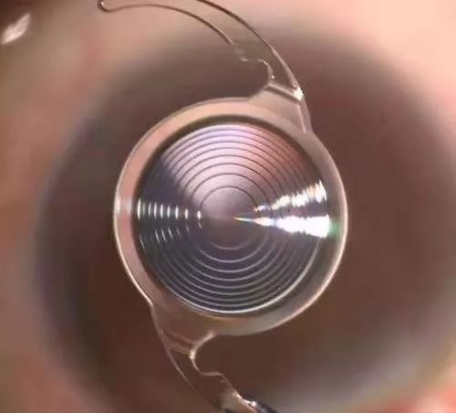 淮安市二院专家成功开展淮安首例TECNIS Symfony人工晶体植入术，让患者恢复清晰视力！