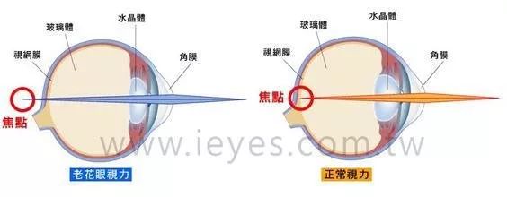 一次性矫正老花+近视+白内障，专家解密TECNIS Symfony®(新无级) 连续视程-人工晶体植入术