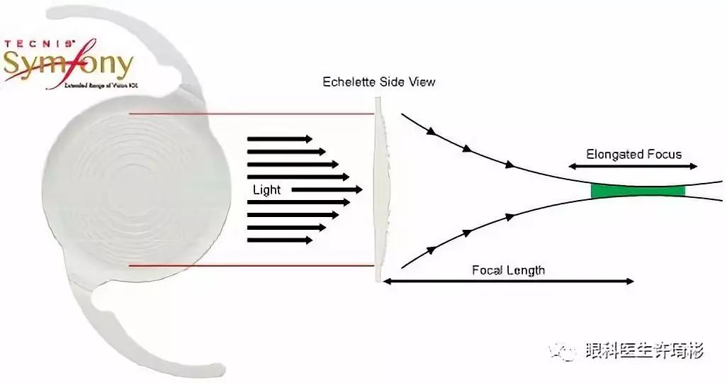 眼科许医生带你了解TECNIS®Symfony（新无级）连续视程人工晶状体