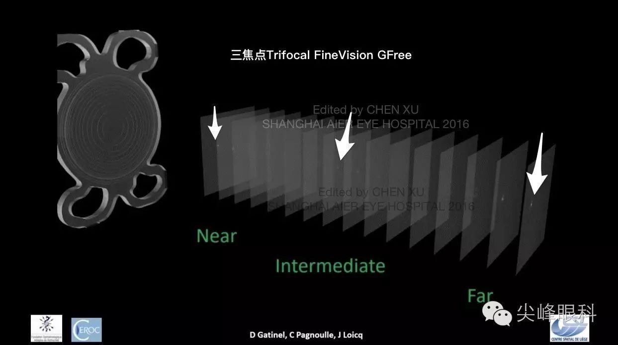 尖峰眼科 | 也谈Symfony新无极人工晶体（下）：纸上谈兵之临床效果比较篇