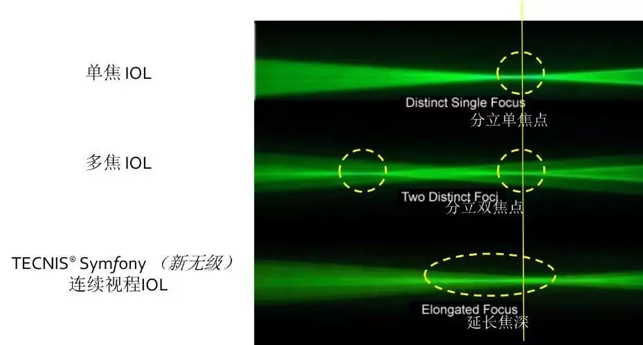 新无级，悦无界——TECNIS Symfony®（新无级）晶英沙龙