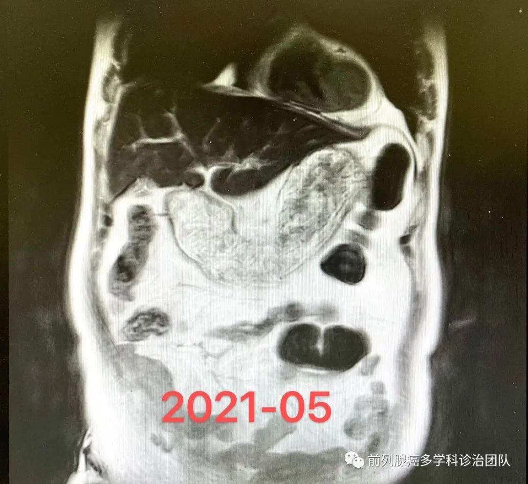 病例分享：一例肝转移mCRPC的精准治疗后完全缓解(10个月随访)